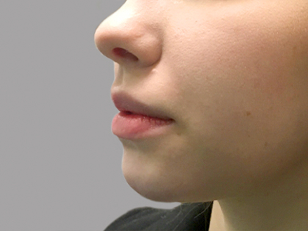 Injectables And Fillers 03