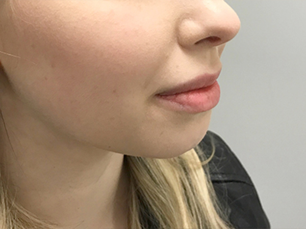 Injectables And Fillers 05