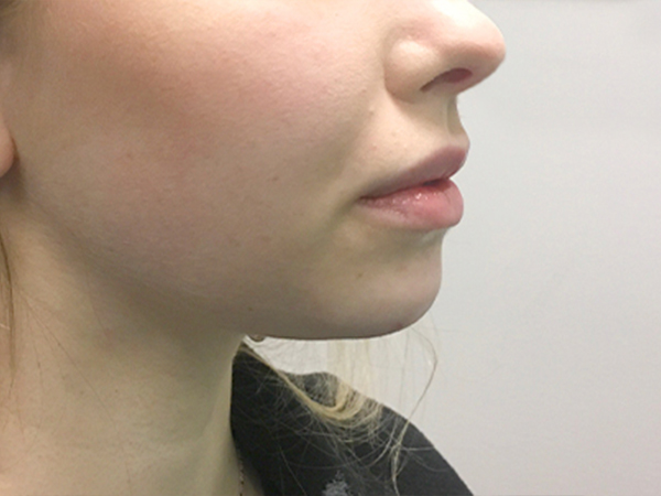 Injectables And Fillers 05