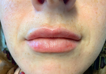 Injectables And Fillers 178