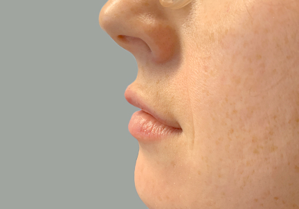 Injectables And Fillers 03