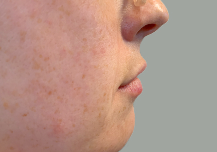 Injectables And Fillers 05