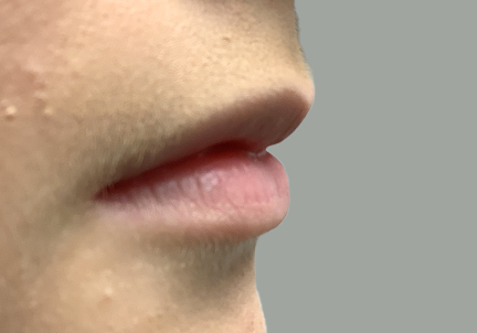 Injectables And Fillers 03