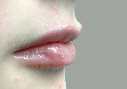 Injectables And Fillers 03