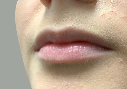 Injectables And Fillers 05