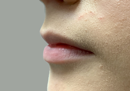 Injectables And Fillers 07