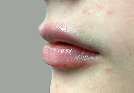 Injectables And Fillers 07