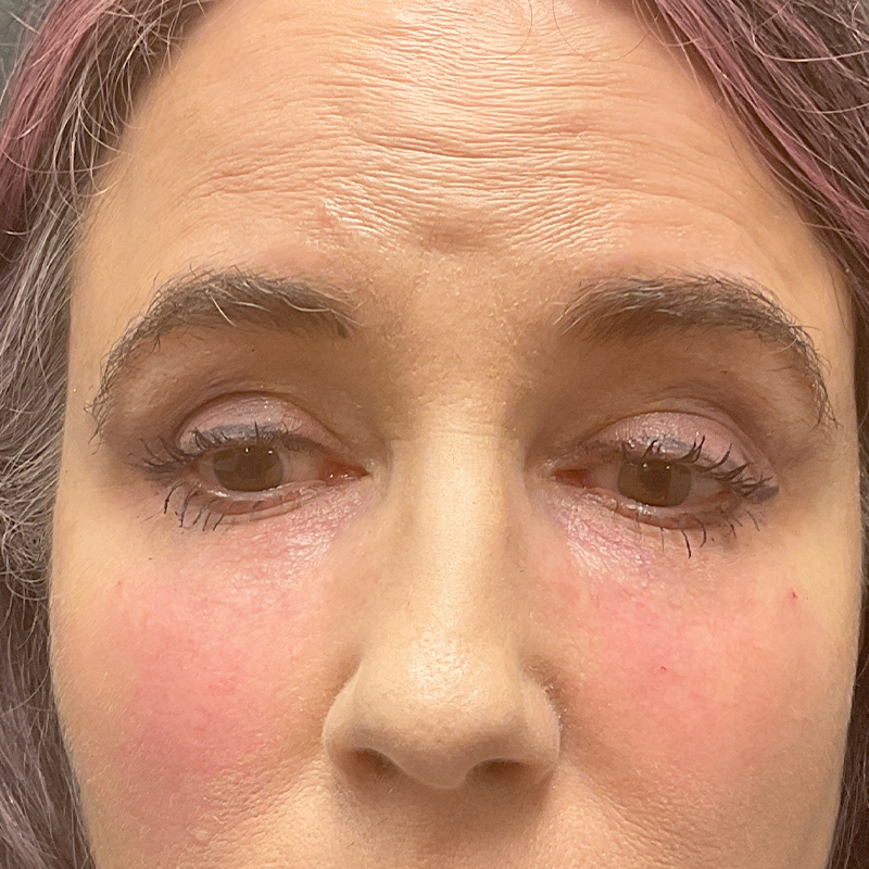 Injectables And Fillers 18