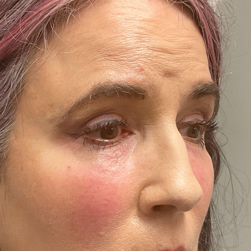 Injectables And Fillers 03