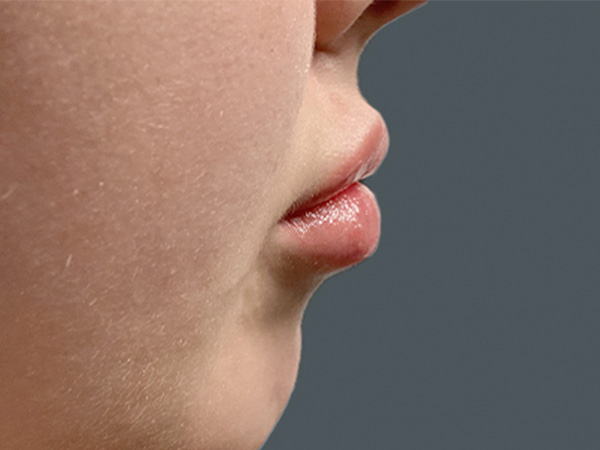 Injectables And Fillers 03