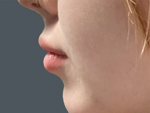 Injectables And Fillers 05