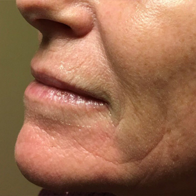 Injectables And Fillers 01