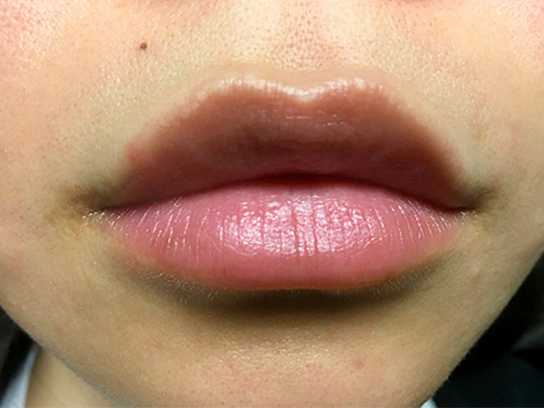 Injectables And Fillers 01