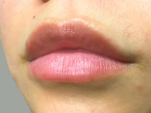 Injectables And Fillers 03