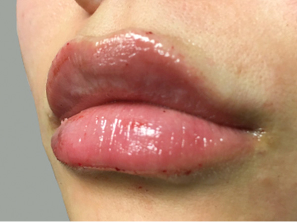 Injectables And Fillers 03