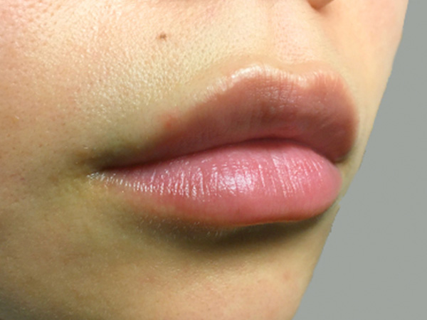 Injectables And Fillers 05