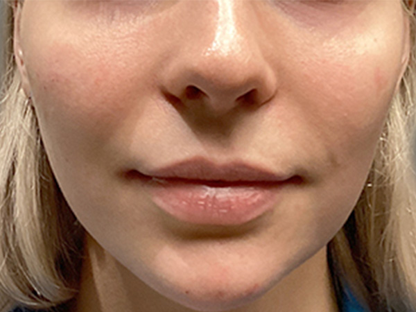 Injectables And Fillers 20