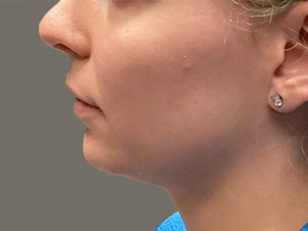 Injectables And Fillers 09