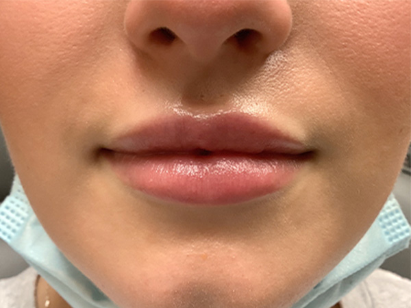 Injectables And Fillers 01