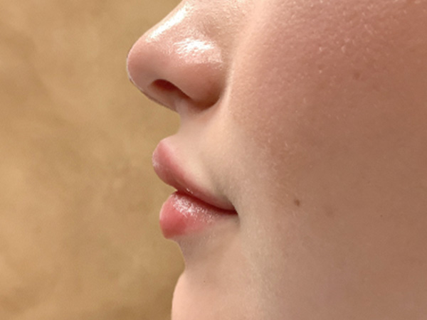 Injectables And Fillers 05