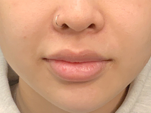 Injectables And Fillers 01