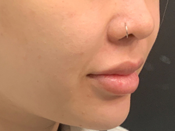 Injectables And Fillers 03