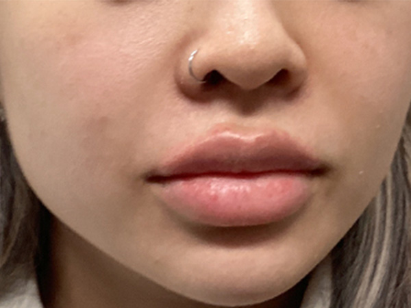 Injectables And Fillers 03