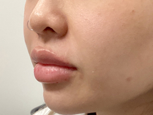 Injectables And Fillers 05