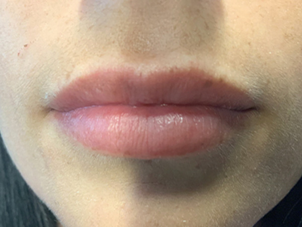 Injectables And Fillers 01