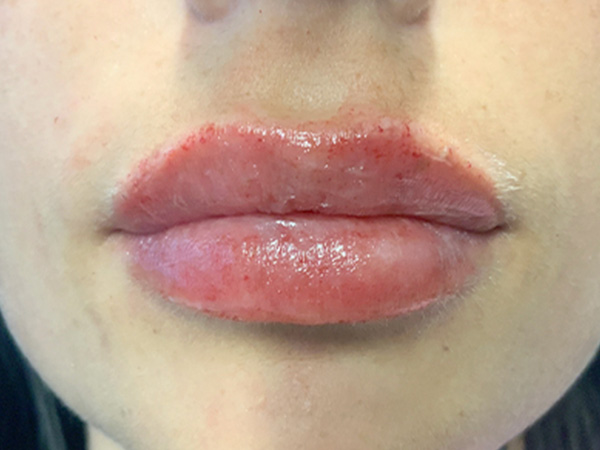 Injectables And Fillers 25