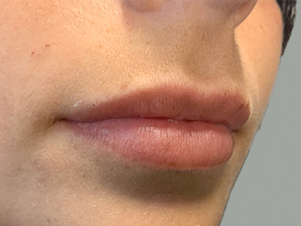 Injectables And Fillers 03