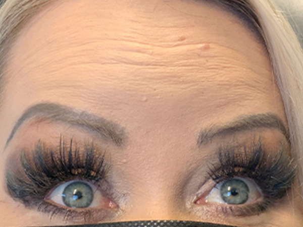 Injectables And Fillers 26