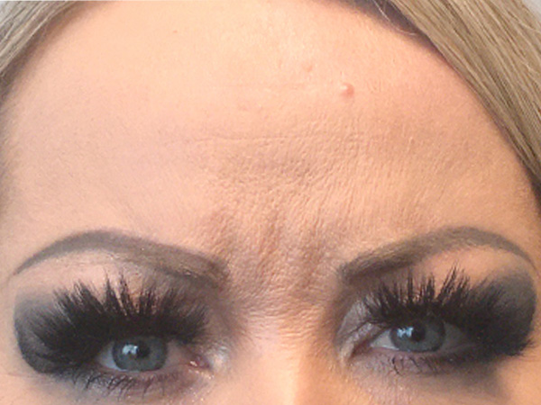 Injectables And Fillers 03