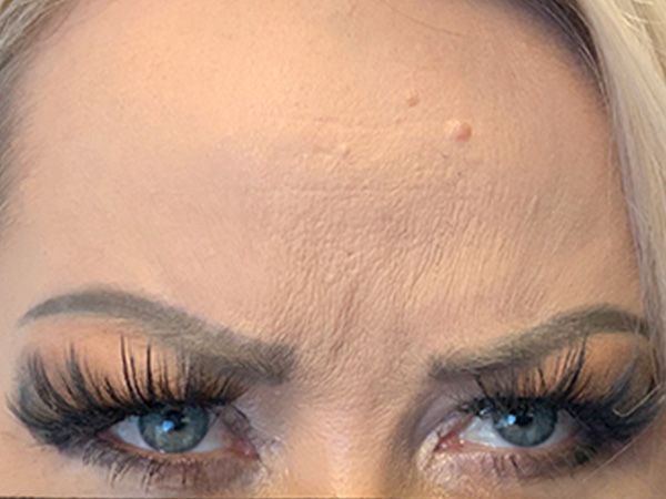 Injectables And Fillers 03