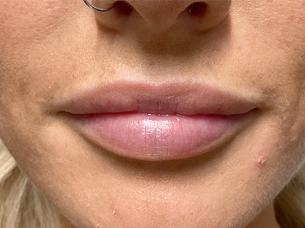 Injectables And Fillers 01