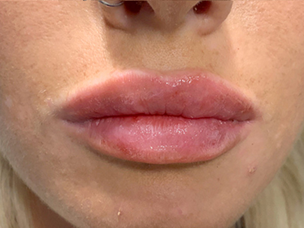 Injectables And Fillers 27