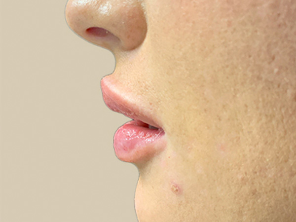 Injectables And Fillers 03