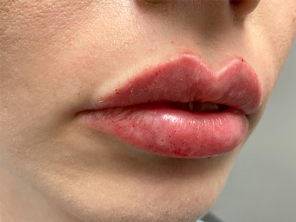 Injectables And Fillers 03