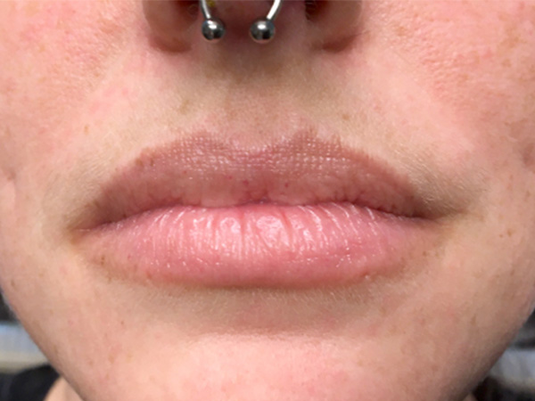 Injectables And Fillers 01