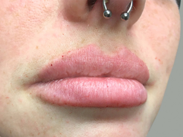 Injectables And Fillers 03