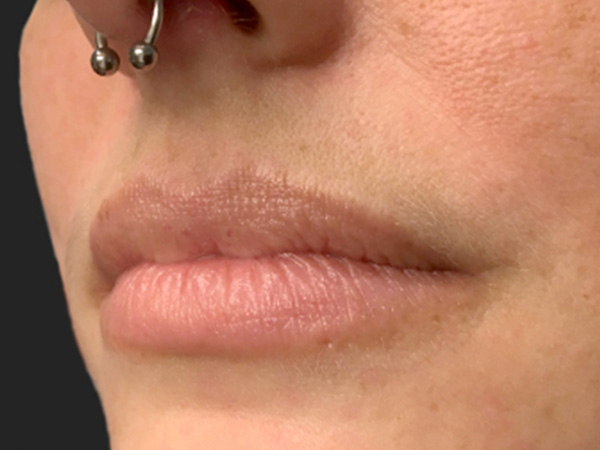 Injectables And Fillers 05