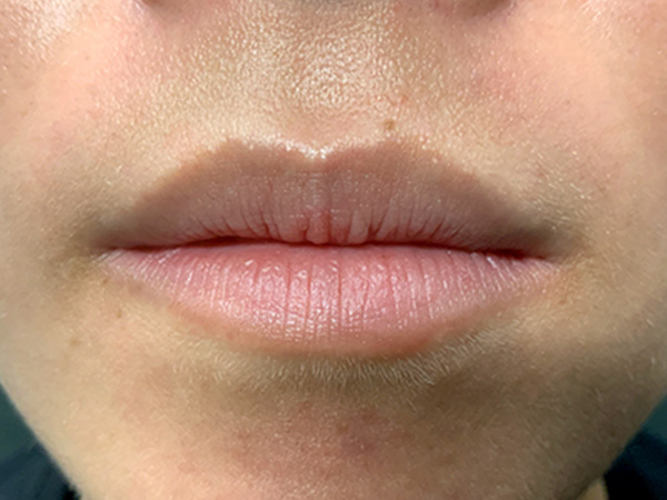 Injectables And Fillers 01