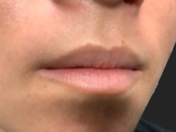 Injectables And Fillers 03