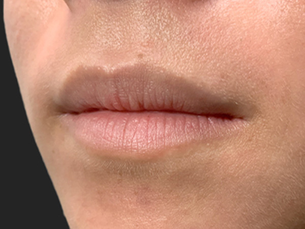 Injectables And Fillers 05