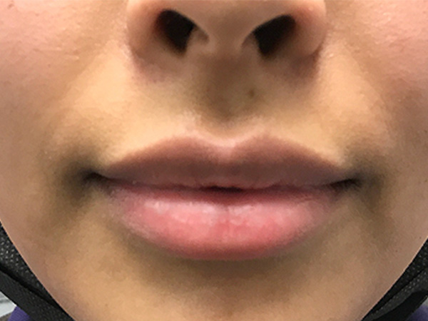 Injectables And Fillers 01