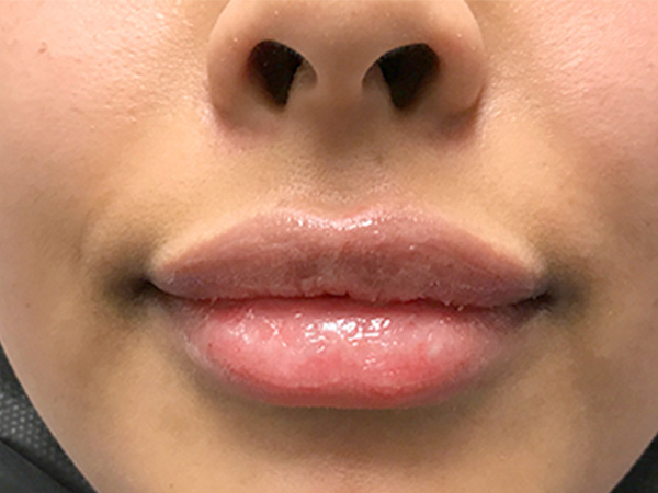 Injectables And Fillers 33