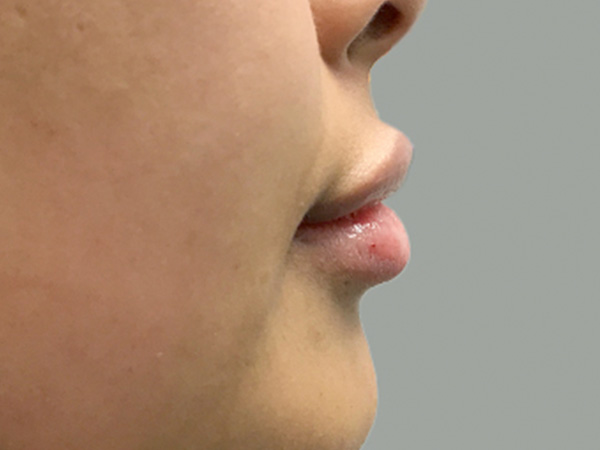 Injectables And Fillers 03