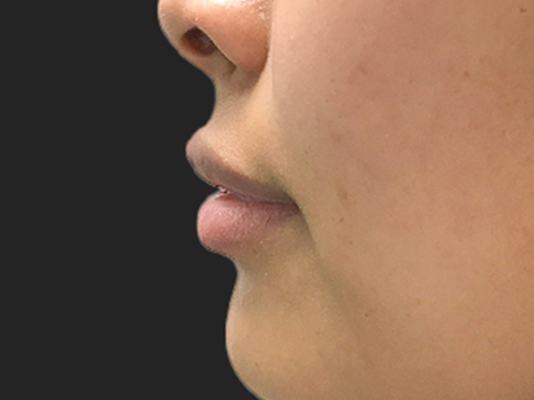 Injectables And Fillers 05