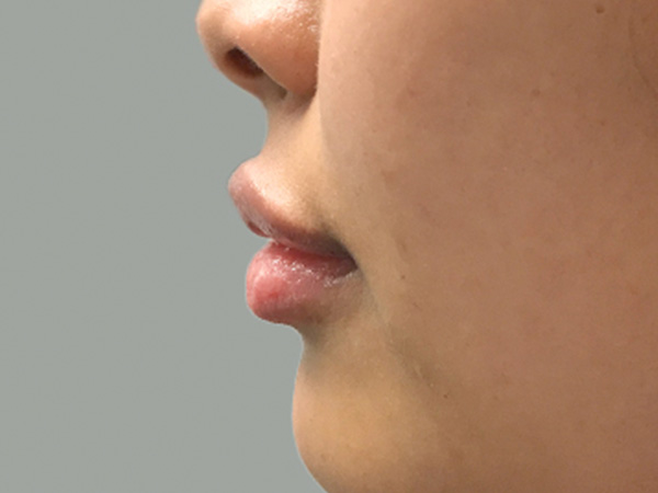 Injectables And Fillers 05