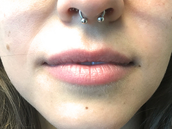 Injectables And Fillers 01